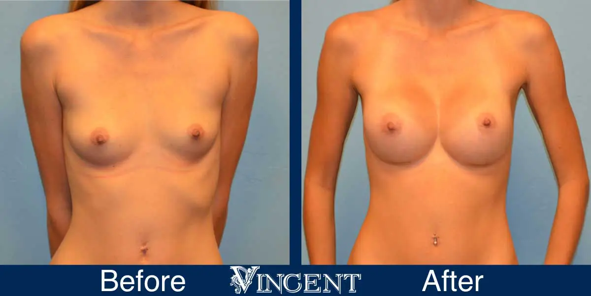 breast-augmentation-before-and-after-salt-lake-city-utah-vincent-surgical-arts-9015-front