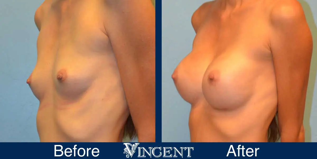 breast-augmentation-before-and-after-salt-lake-city-utah-vincent-surgical-arts-9015-left