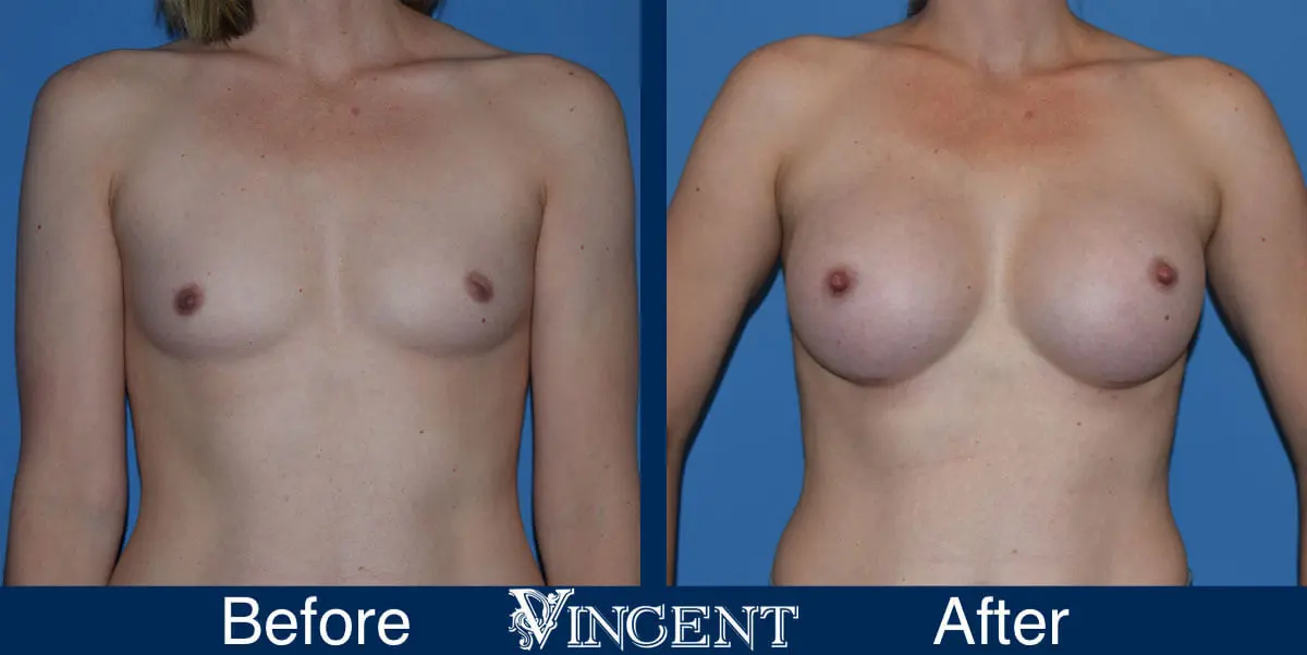 breast-augmentation-before-and-after-salt-lake-city-utah-vincent-surgical-arts-913727-front