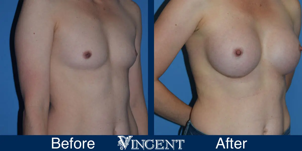 breast-augmentation-before-and-after-salt-lake-city-utah-vincent-surgical-arts-913727-right