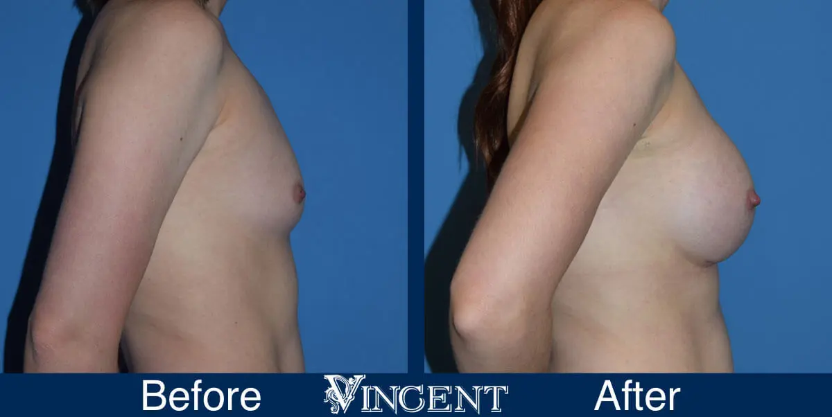 breast-augmentation-before-and-after-salt-lake-city-utah-vincent-surgical-arts-913727-side