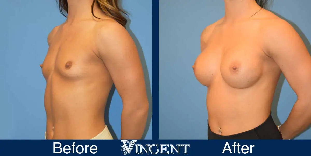 breast-augmentation-before-and-after-salt-lake-city-utah-vincent-surgical-arts-914846-left