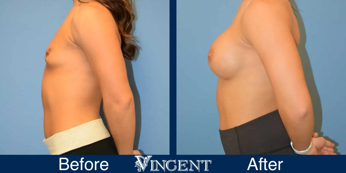 breast-augmentation-before-and-after-salt-lake-city-utah-vincent-surgical-arts-914846-side