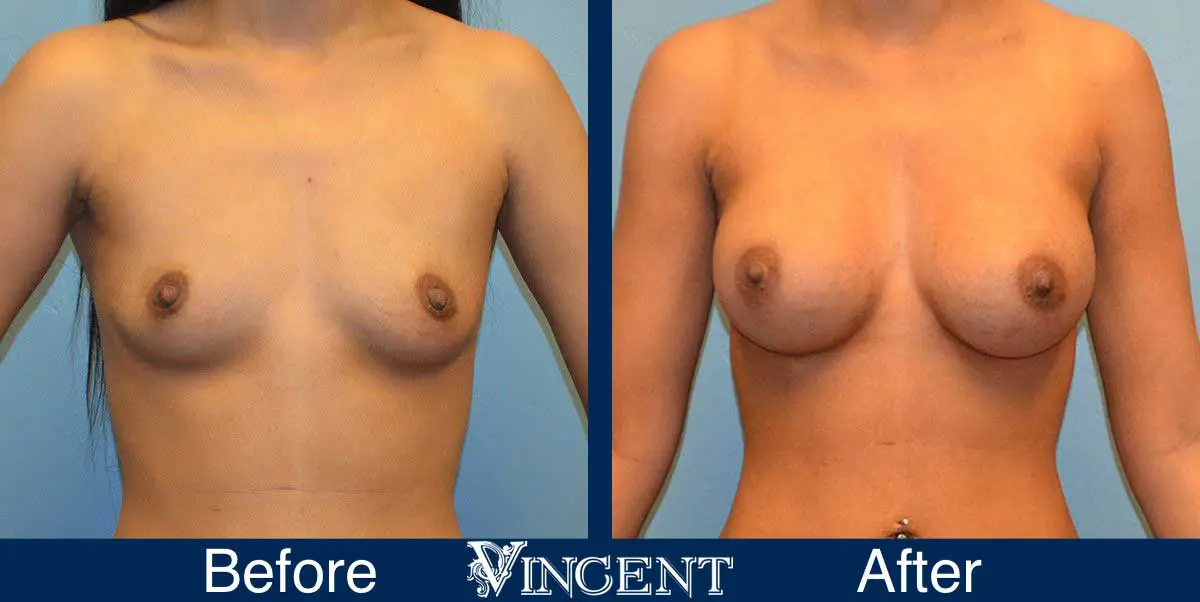 breast-augmentation-before-and-after-salt-lake-city-utah-vincent-surgical-arts-Front-9006