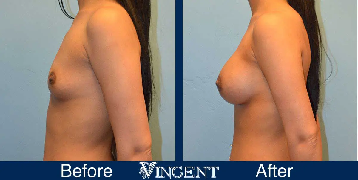 breast-augmentation-before-and-after-salt-lake-city-utah-vincent-surgical-arts-Full-Left-9006