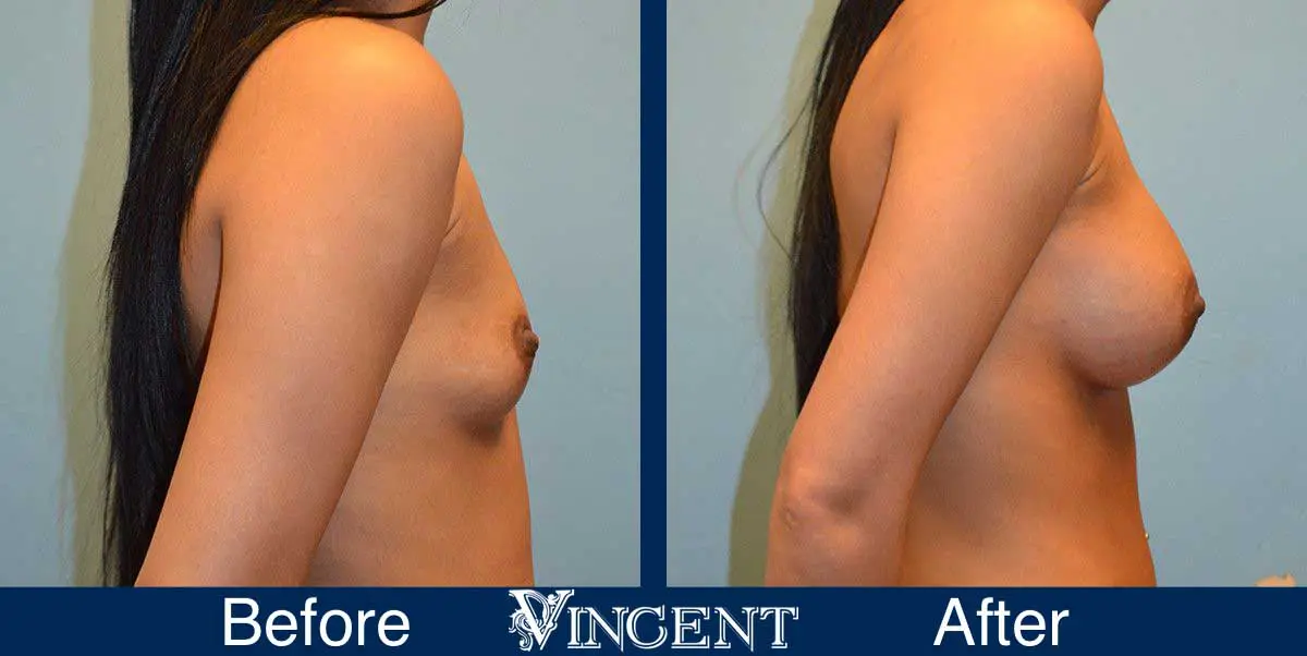 breast-augmentation-before-and-after-salt-lake-city-utah-vincent-surgical-arts-Full-Right-9006