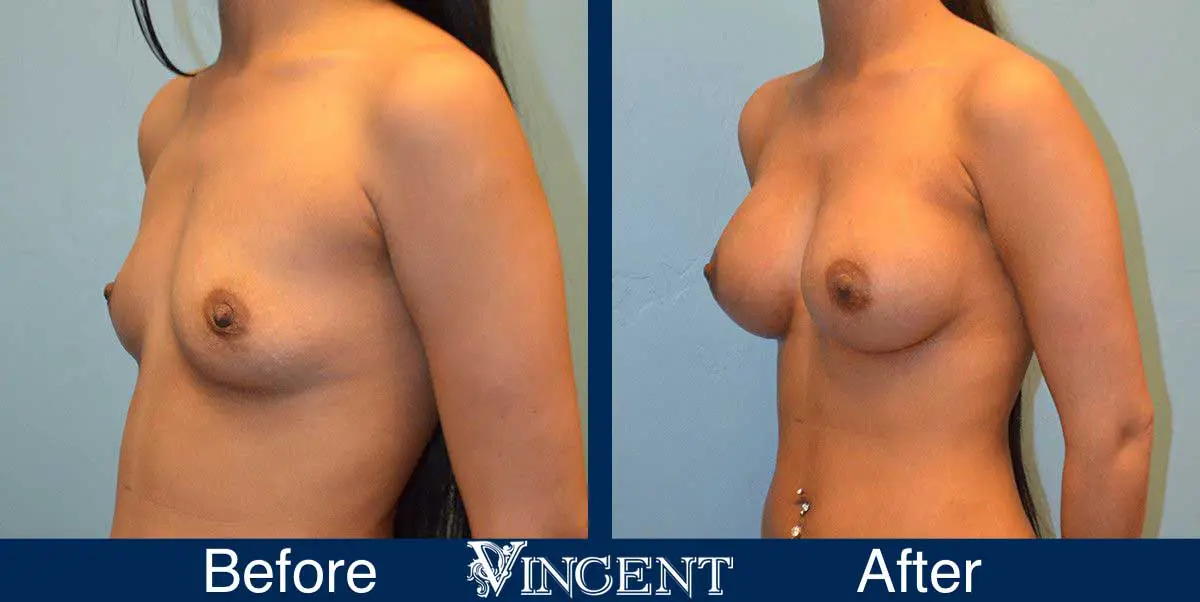 breast-augmentation-before-and-after-salt-lake-city-utah-vincent-surgical-arts-Left-9006