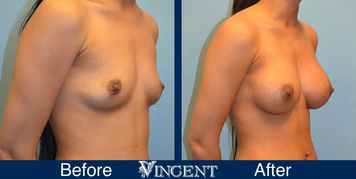 breast-augmentation-before-and-after-salt-lake-city-utah-vincent-surgical-arts-Right-9006