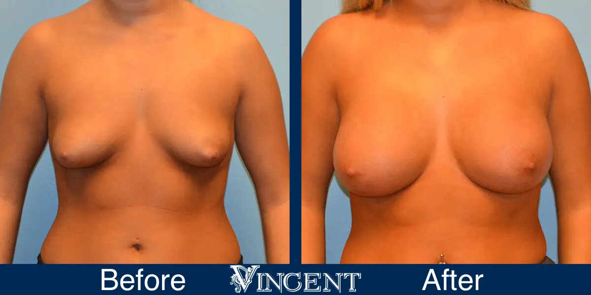 breast-implants-before-and-after-utah-front-9001