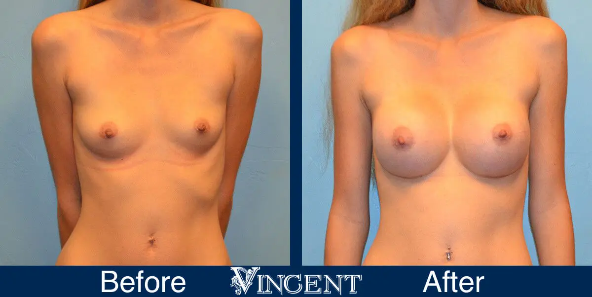 breast-implants-before-and-after-utah-front-9002