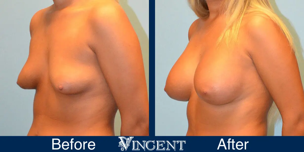 breast-implants-before-and-after-utah-left-9001