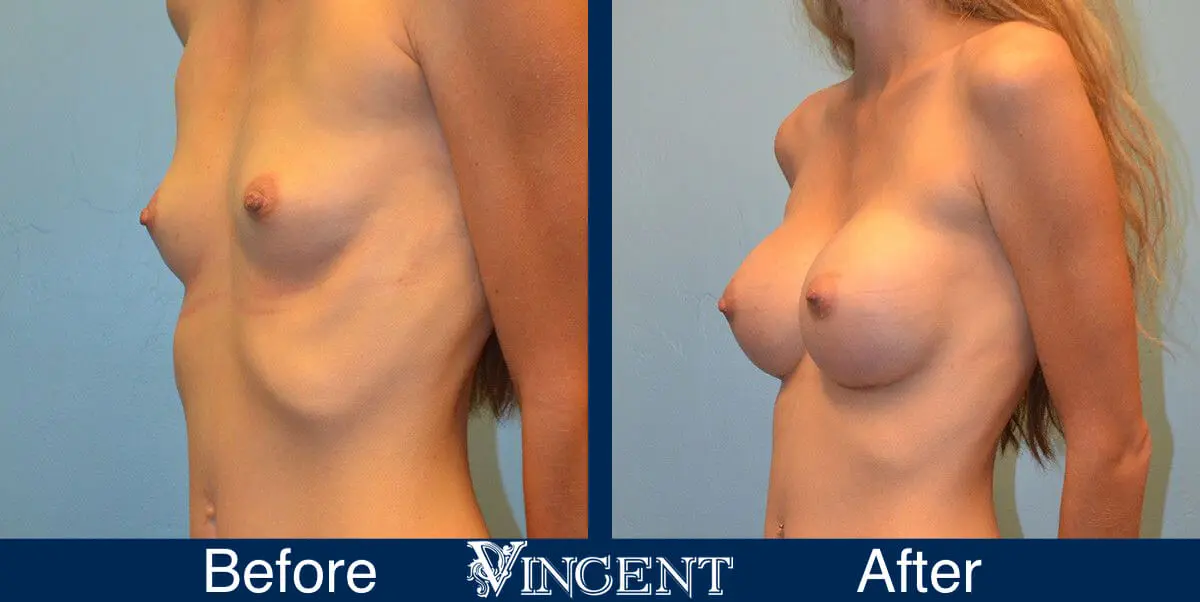 breast-implants-before-and-after-utah-left-9002