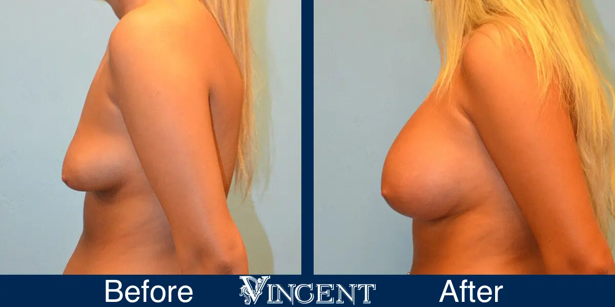 breast-implants-before-and-after-utah-left-side-9001