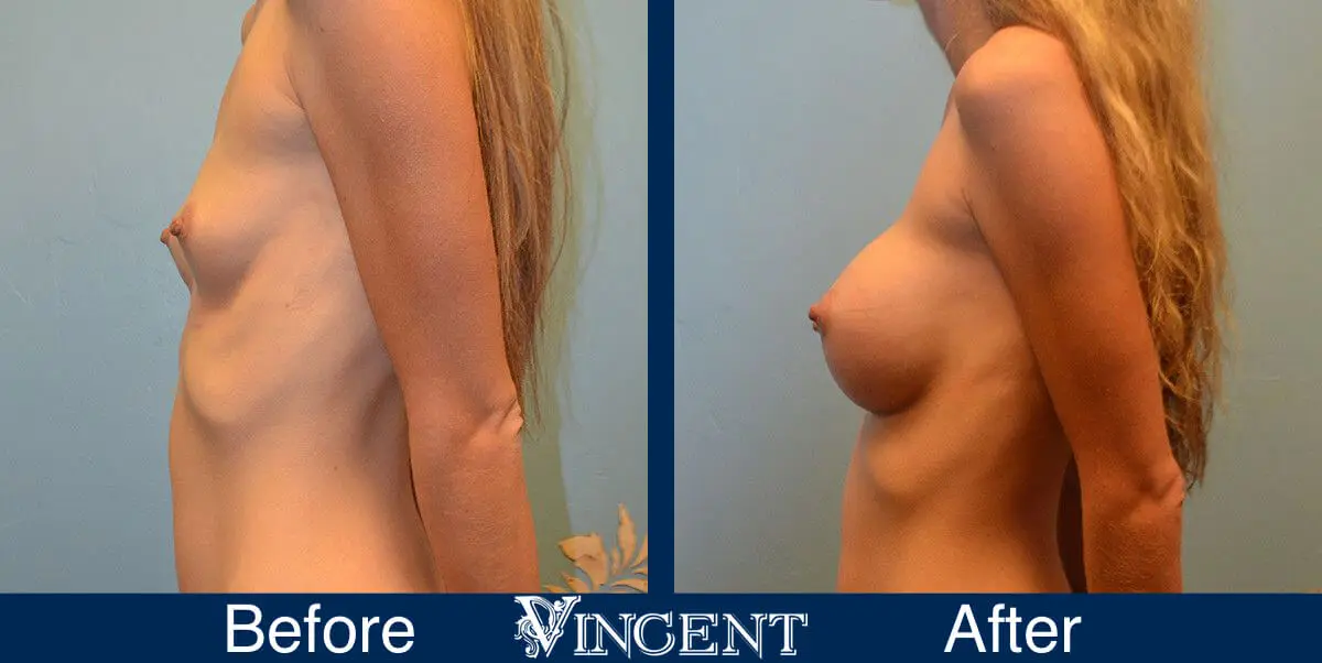 breast-implants-before-and-after-utah-left-side-9002