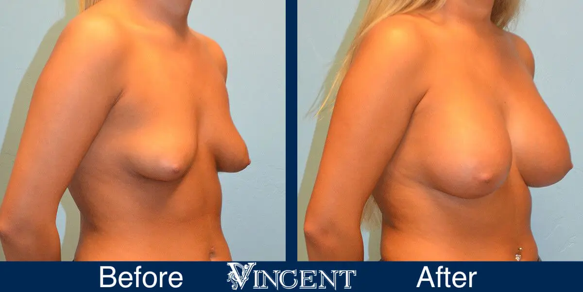 breast-implants-before-and-after-utah-right-9001