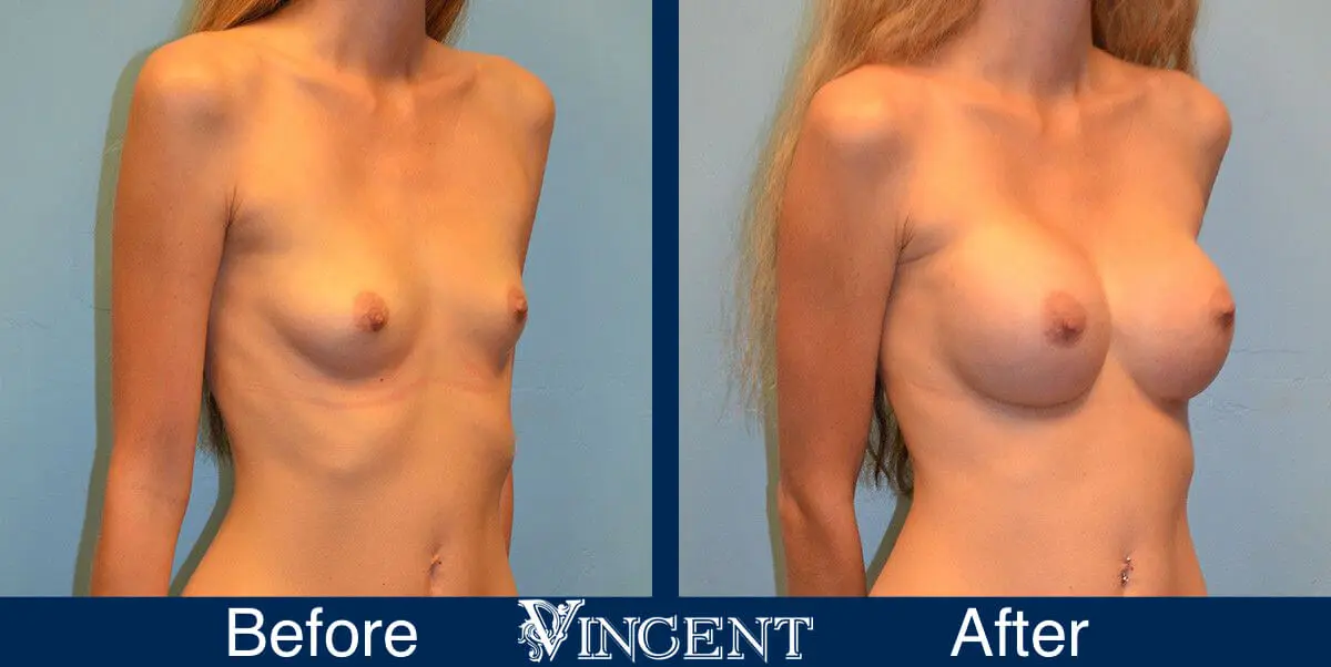 breast-implants-before-and-after-utah-right-9002