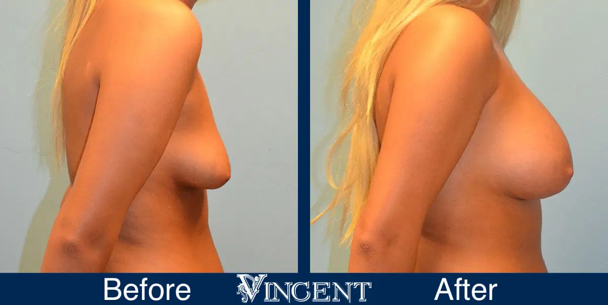 breast-implants-before-and-after-utah-right-side-9001