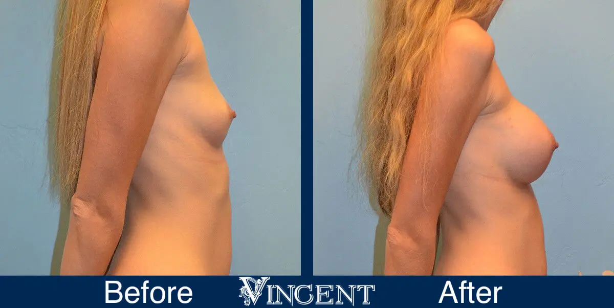 breast-implants-before-and-after-utah-right-side-9002
