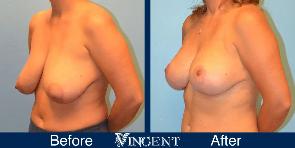 breast-lift-before-and-after-utah-8001-Left