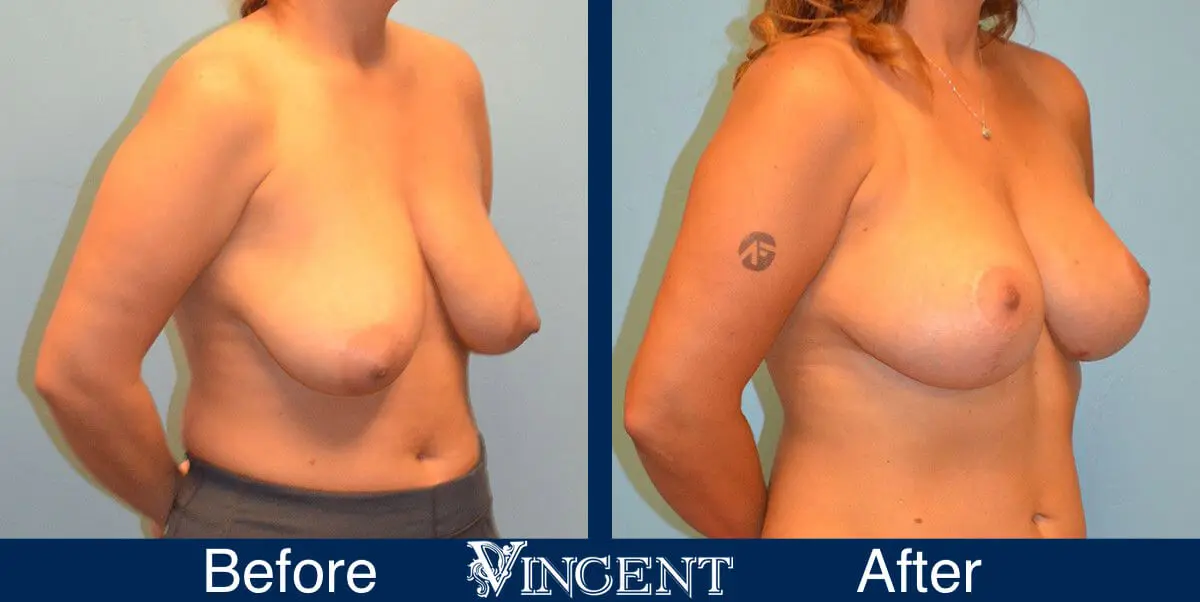 breast-lift-before-and-after-utah-8001-Right