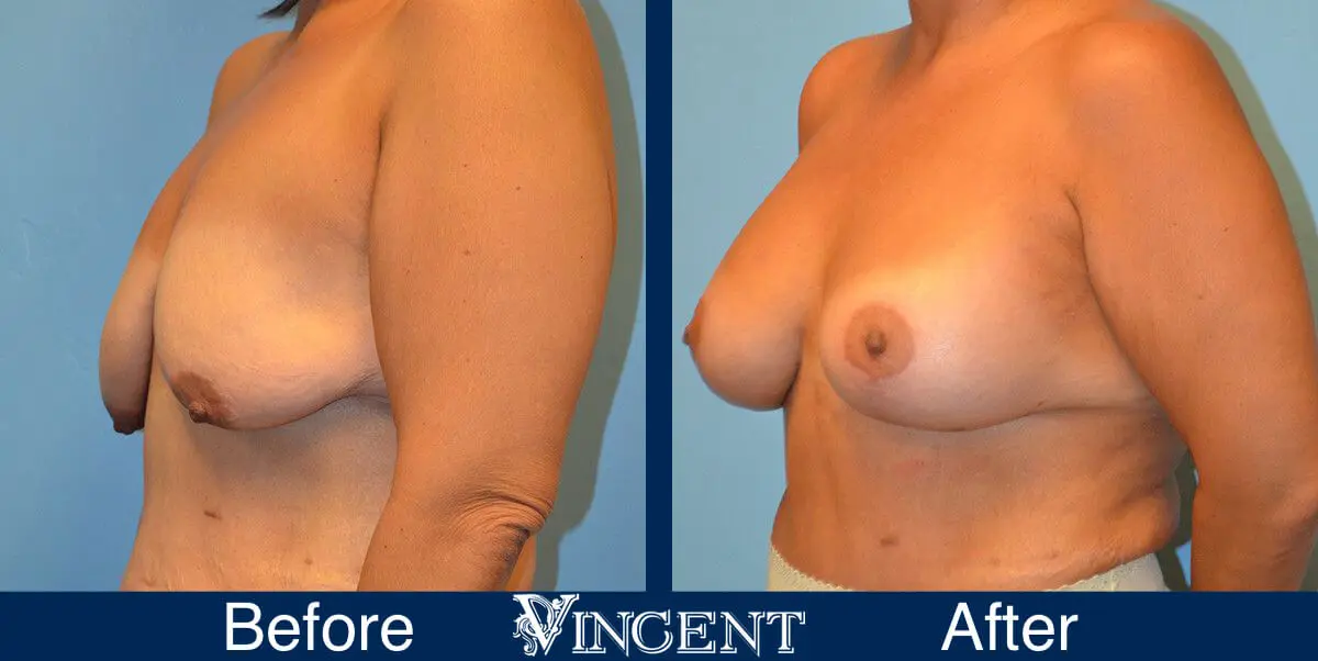 breast-lift-before-and-after-utah-8004-Left