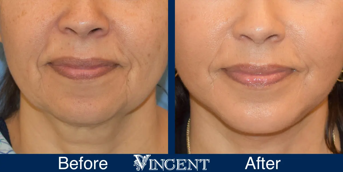 chin-implant-before-and-after-female-utah-front-1