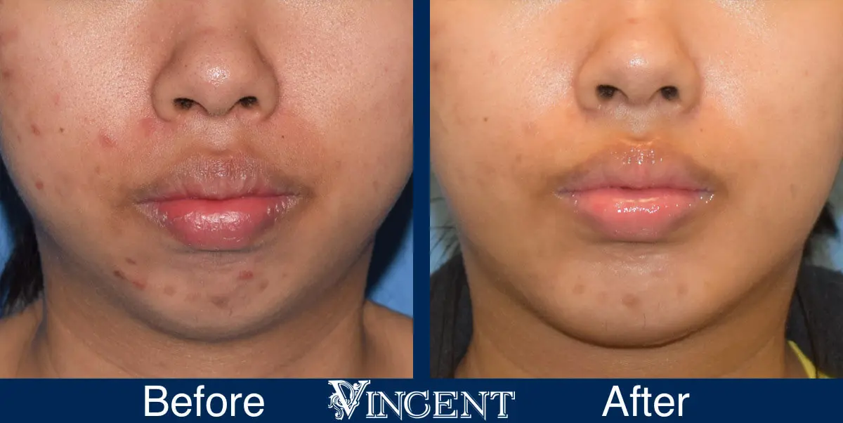 chin-implant-before-and-after-female-utah-front
