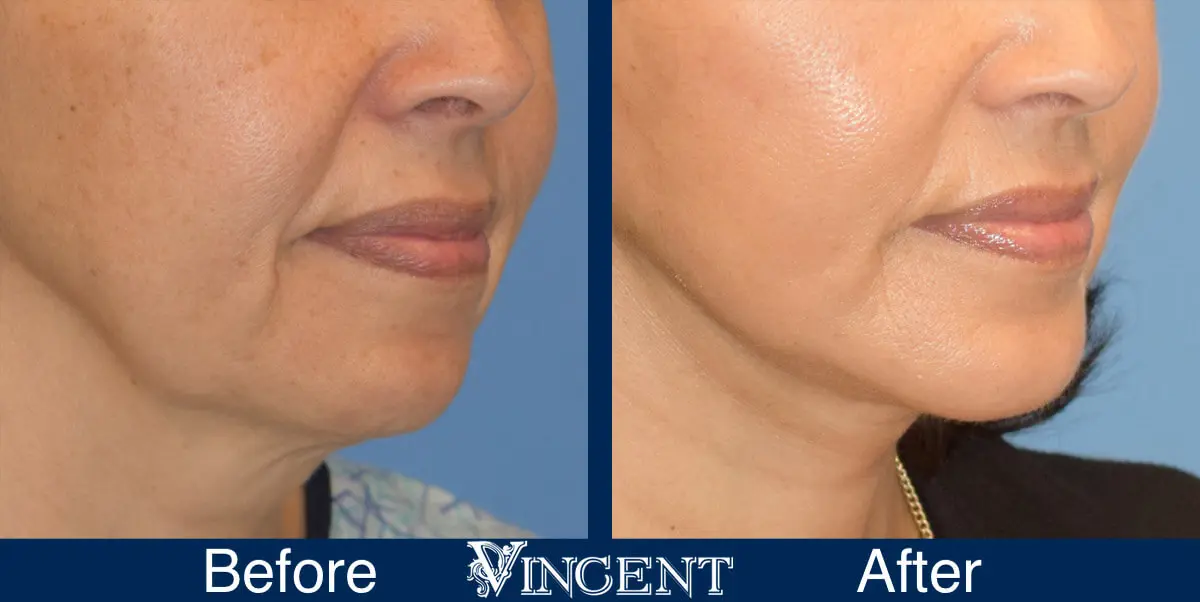 chin-implant-before-and-after-female-utah-right-1
