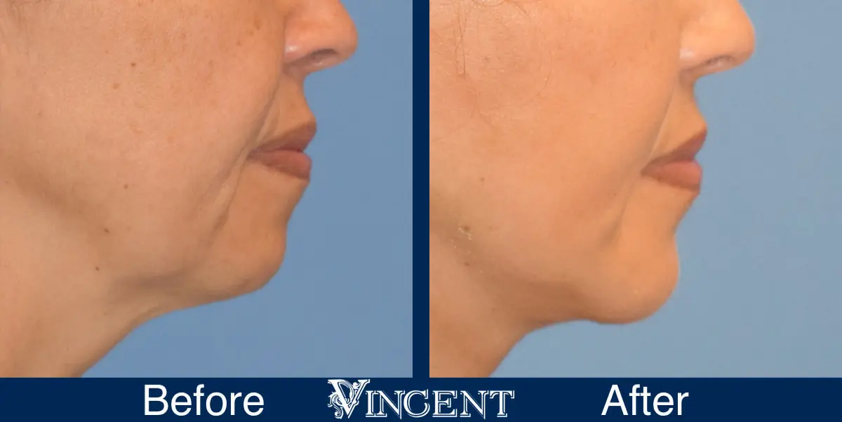 chin-implant-before-and-after-female-utah-side-1