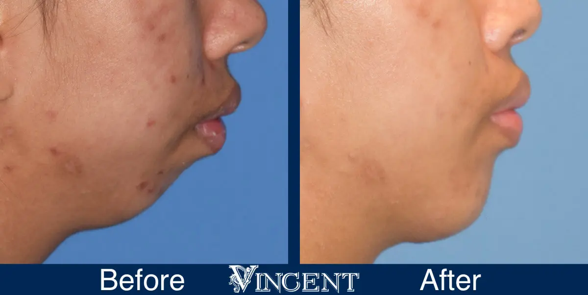 chin-implant-before-and-after-female-utah-side