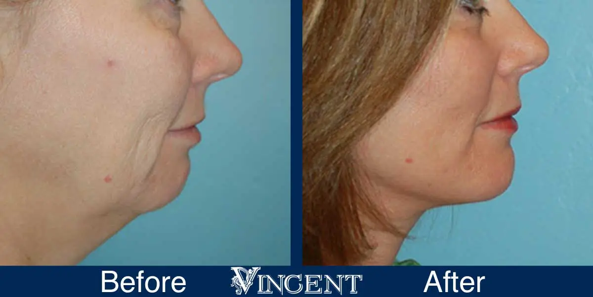 chin-implant-before-and-after-utah-0902-front
