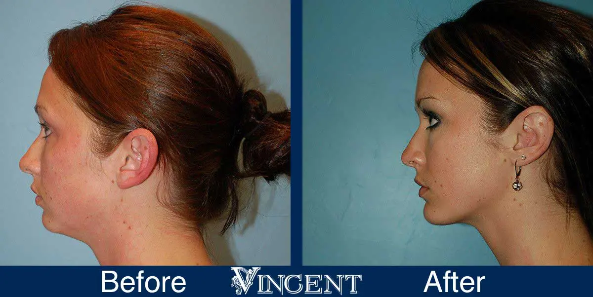 chin-implant-before-and-after-utah-0903_left2