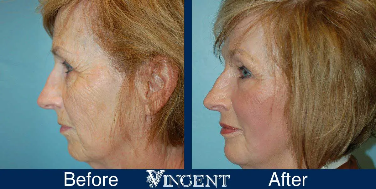 co2-laser-treatment-before-and-after-utah-vincent-surgical-arts-2002_front_fattransfer_left