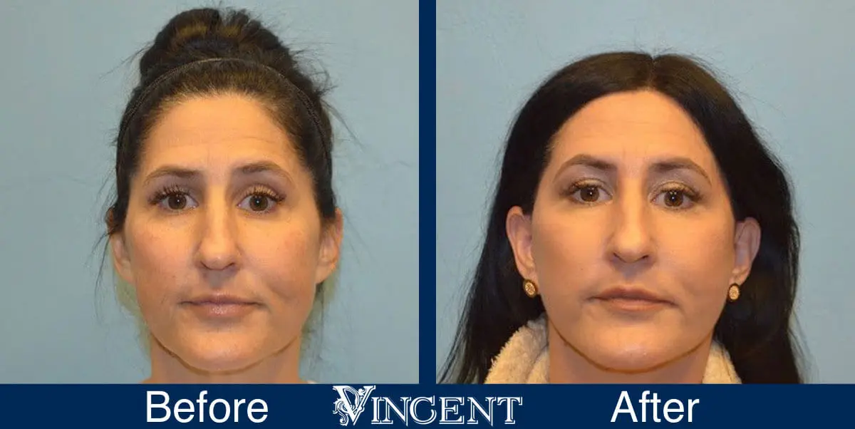 facelift-before-and-after-1003_Swiftlift_front1