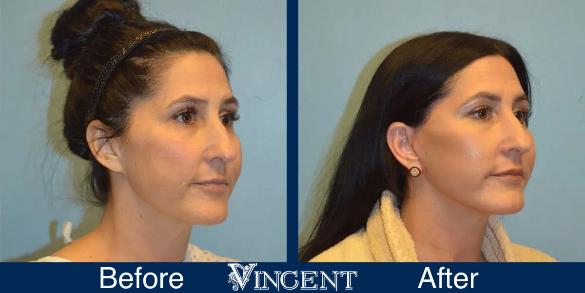 facelift-before-and-after-1003_Swiftlift_right