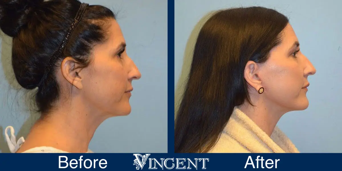 facelift-before-and-after-1003_Swiftlift_right_2