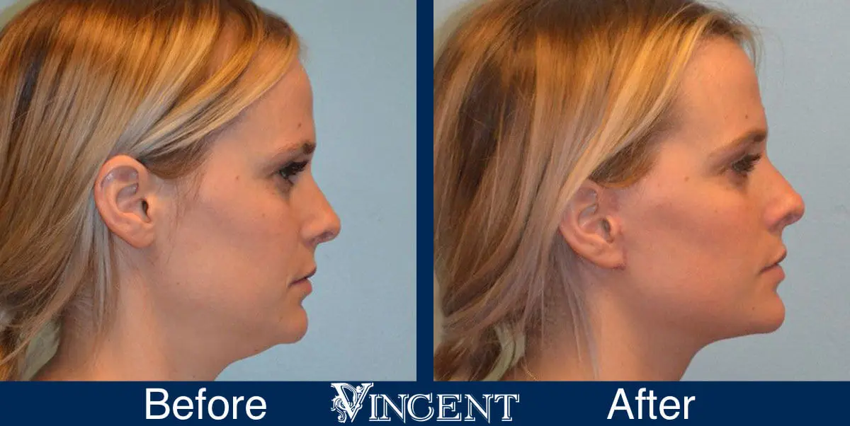 facelift-before-and-after-salt-lake-city-utah-1002_Swiftlift_right_3