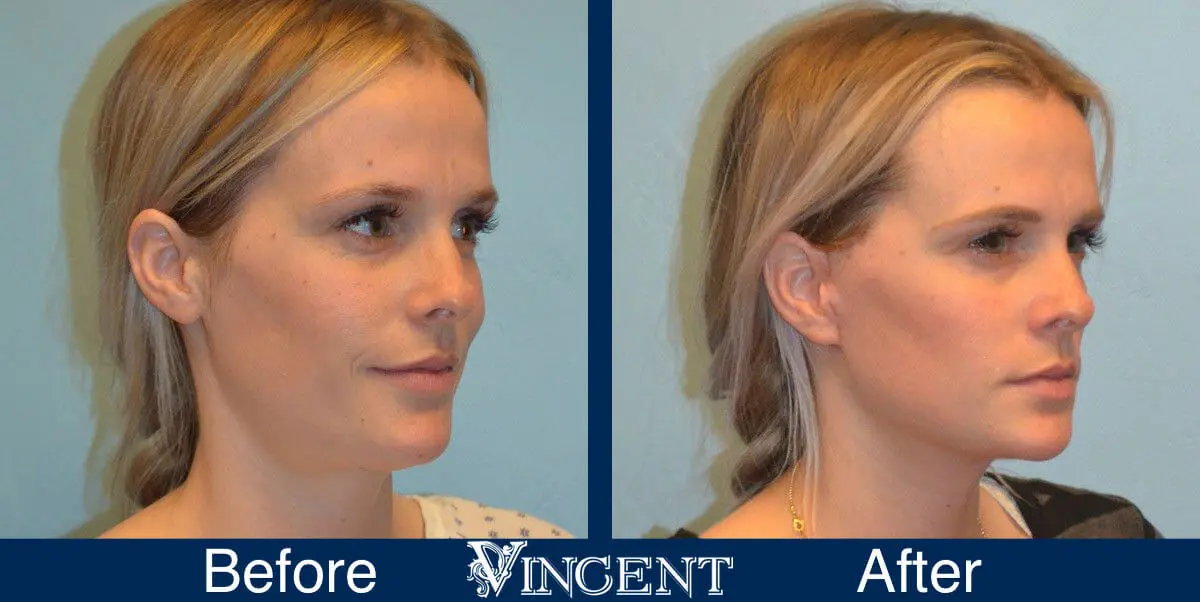 facelift-before-and-after-salt-lake-city-utah-1002_Swiftlift_right_4