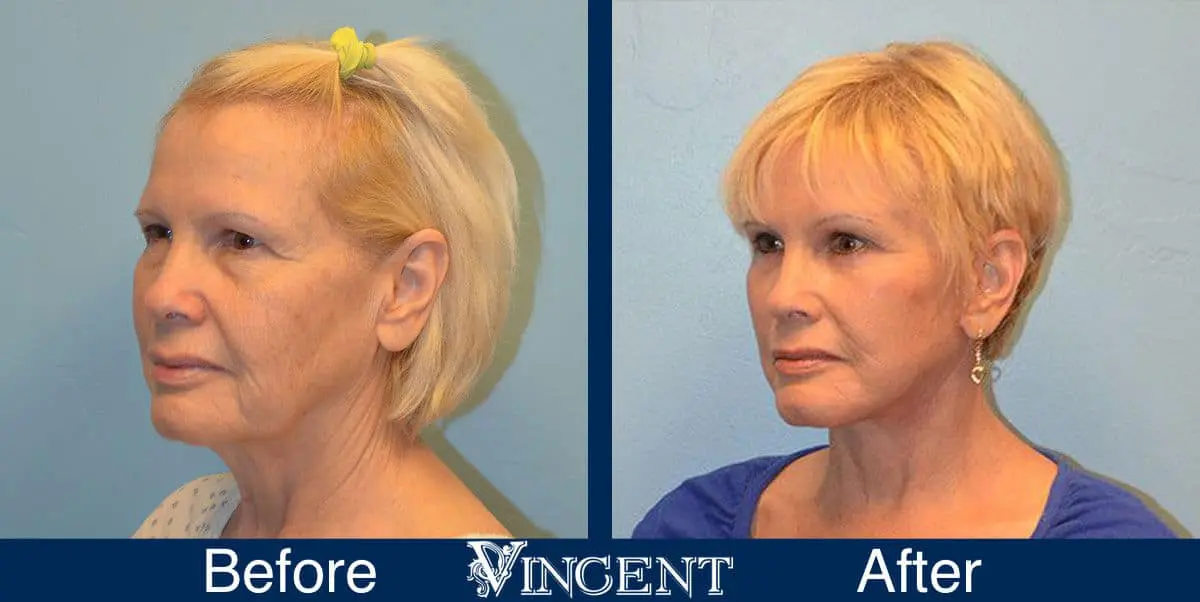 facelift-before-and-after-salt-lake-city-utah-1005-Updated-left-front-view