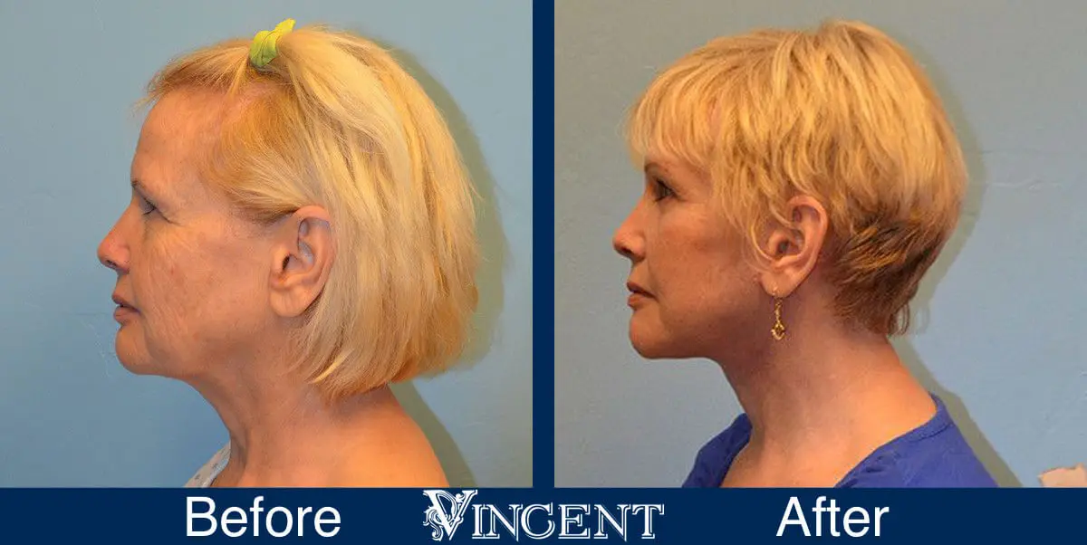 facelift-before-and-after-salt-lake-city-utah-1005-updated-left-side-view