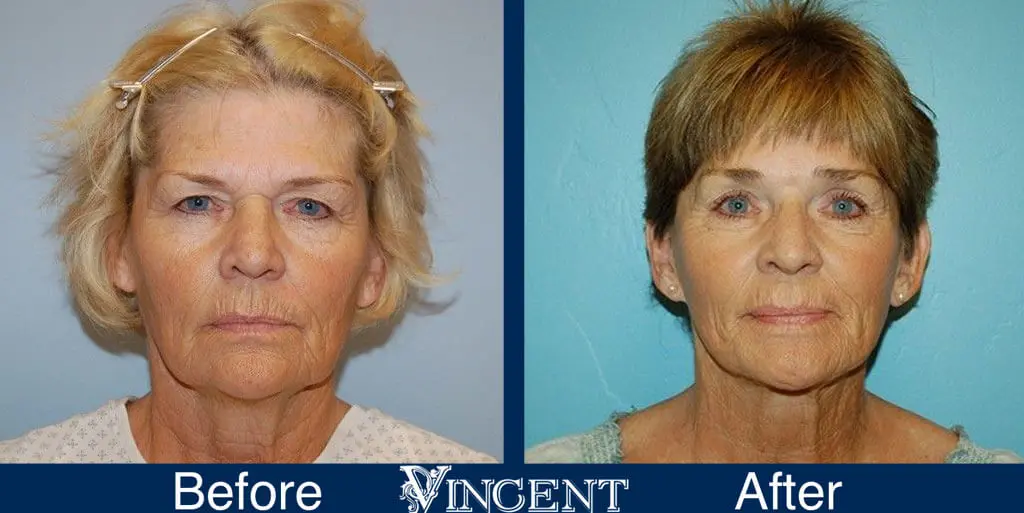 facelift-before-and-after-salt-lake-city-utah-1006-updated-front-view