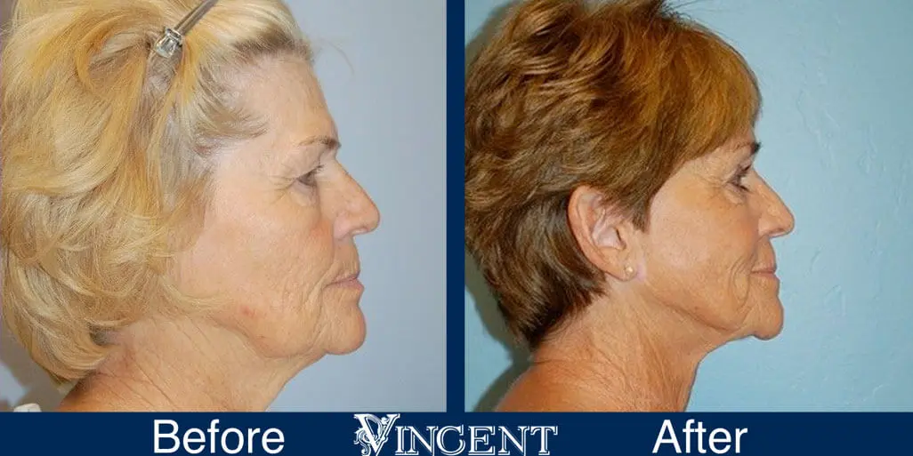 facelift-before-and-after-salt-lake-city-utah-1006-updated-left-side-view