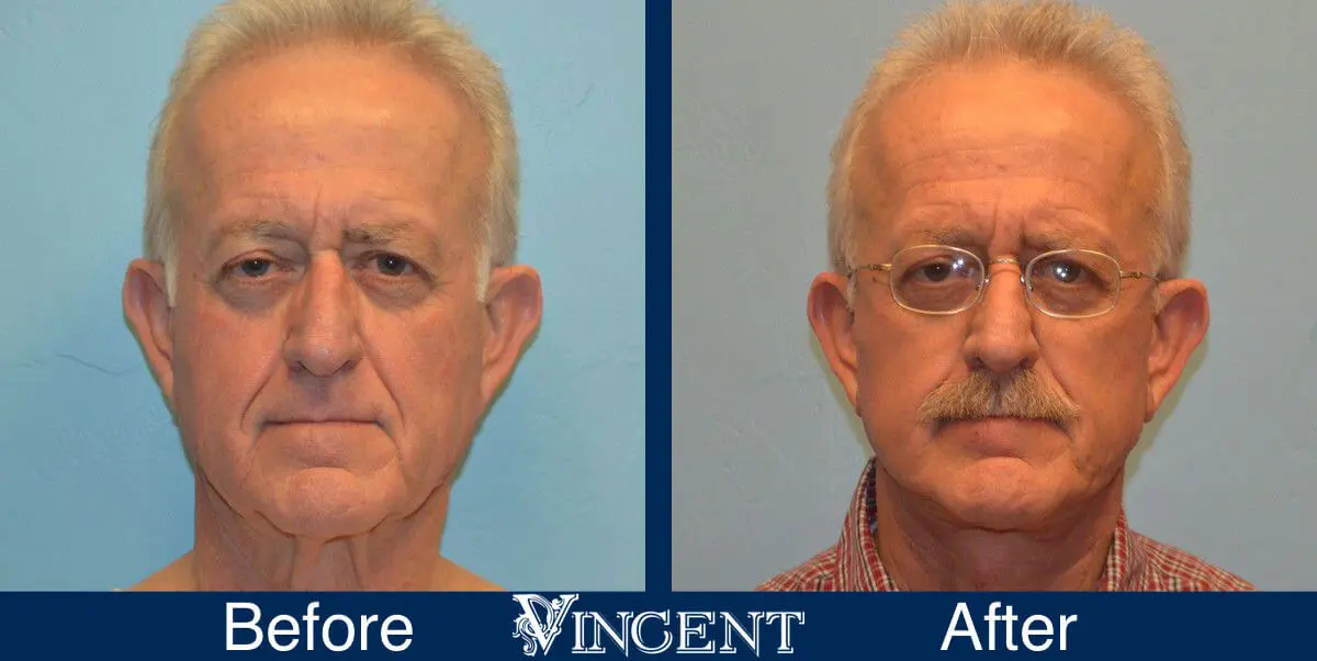 facelift-before-and-after-salt-lake-city-utah-1007_front1