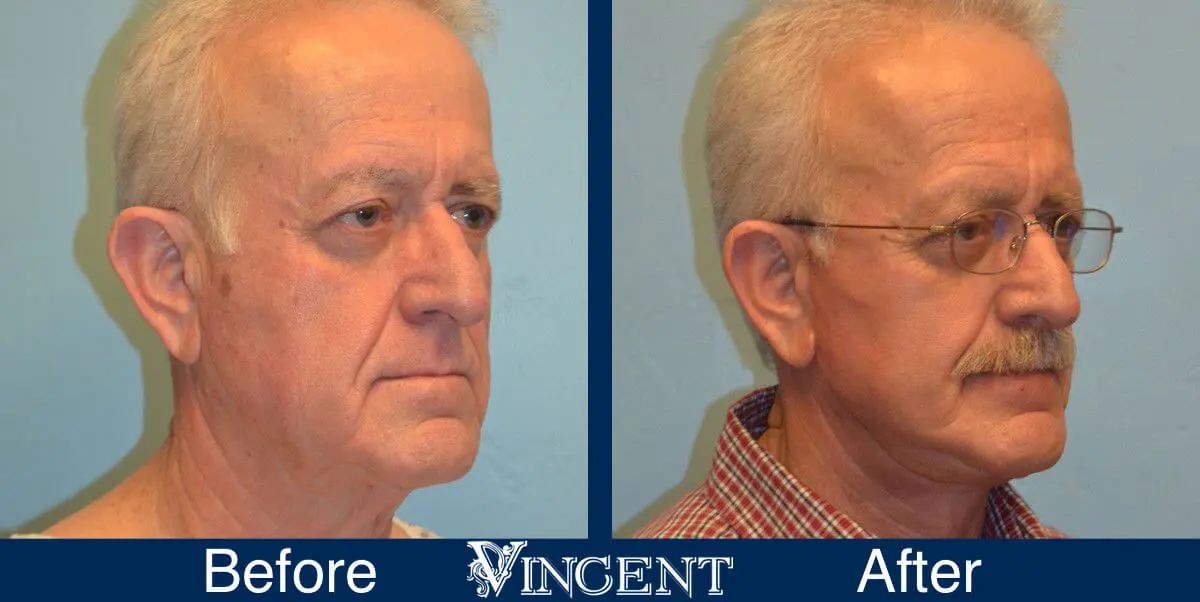 facelift-before-and-after-salt-lake-city-utah-1007_leftside