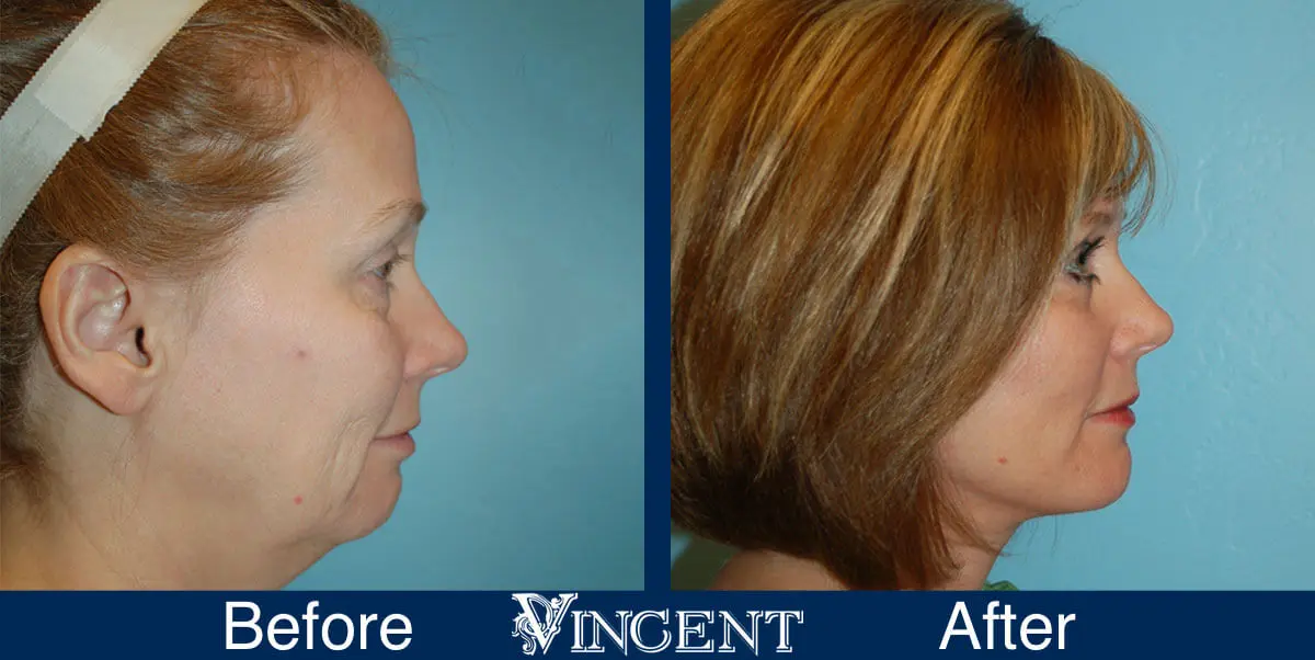 facelift-before-and-after-salt-lake-city-utah-1008_Swiftlift-3