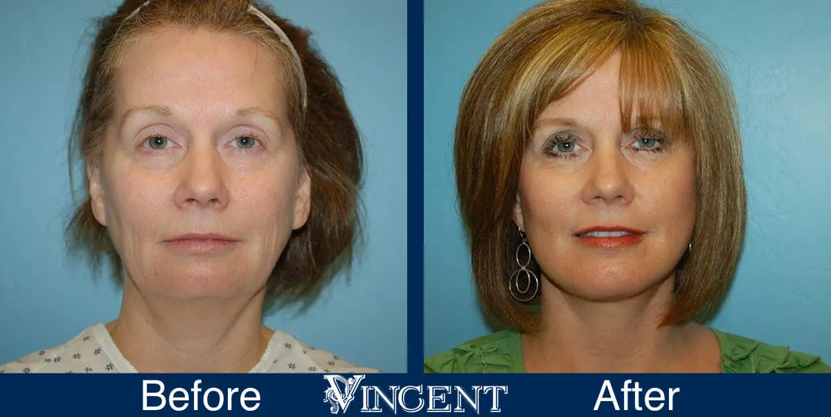 facelift-before-and-after-salt-lake-city-utah-1008_front2