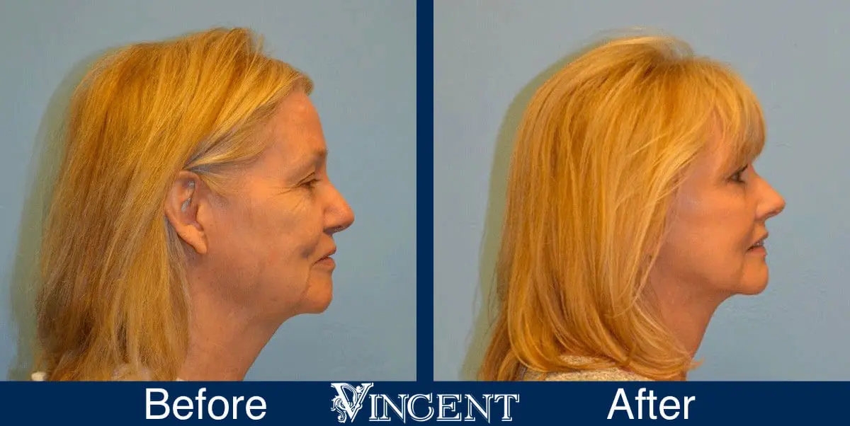 facelift-before-and-after-salt-lake-city-utah-1009_right1