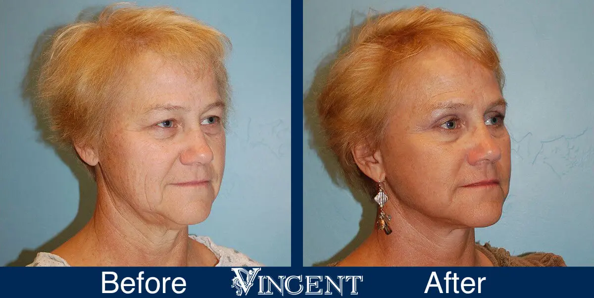 facelift-before-and-after-salt-lake-city-utah-1014_SwiftLift_w_extension_upper_blephs_side-1
