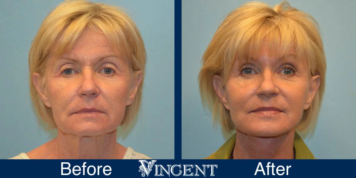 facelift-before-and-after-salt-lake-city-utah-1015_SwiftLift_w_extension_frontview-1