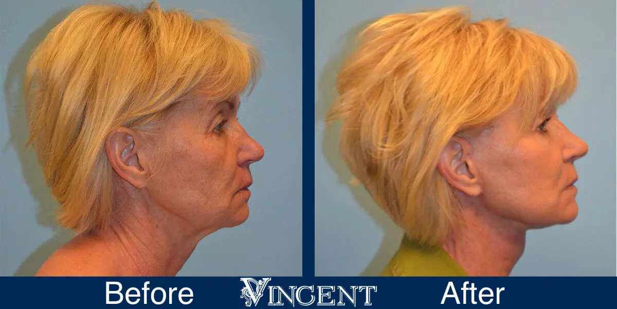 facelift-before-and-after-salt-lake-city-utah-1015_SwiftLift_w_extension_sideview-1